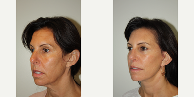 Neck Lift before and after photo