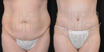 Tummy Tuck before and after photo
