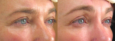 Ultherapy before and after photo