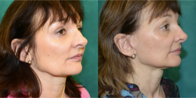 Facelift before and after photo