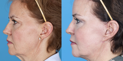 Facial Fat Transfer before and after photo