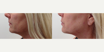 Thread Lift before and after photo