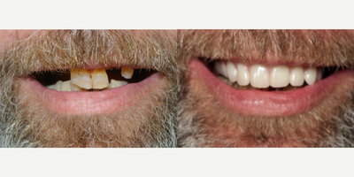 All-on-4 Dental Implants before and after photo