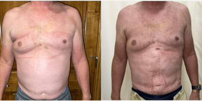 BodyTite before and after photo