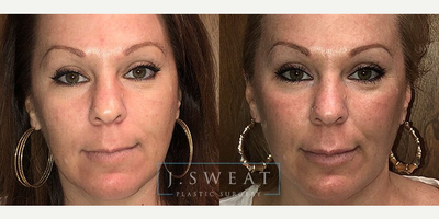 Botox before and after photo