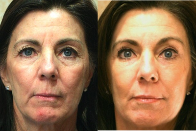 CO2 Laser before and after photo