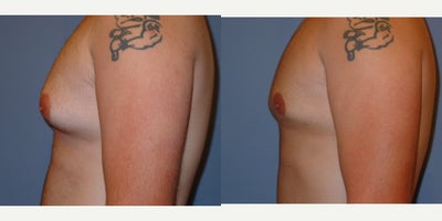 Gynecomastia Surgery before and after photo