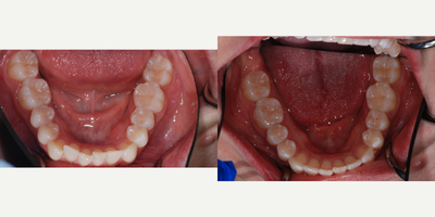 Invisalign before and after photo