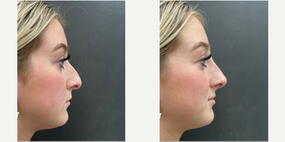 Nonsurgical Nose Job before and after photo