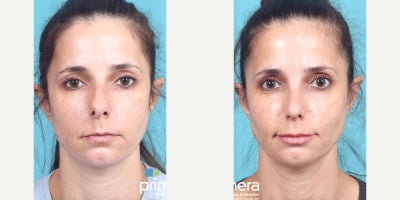 Rhinoplasty before and after photo