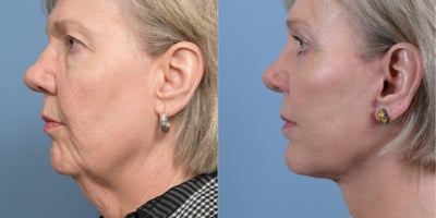 Brow Lift before and after photo