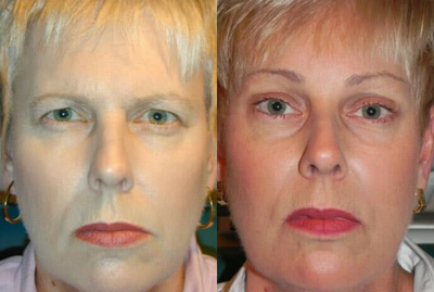 Brow Lift before and after photo