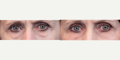 Eyelid Surgery before and after photo