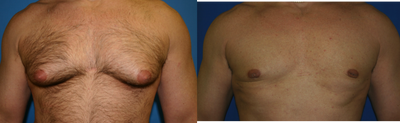 Gynecomastia Surgery before and after photo
