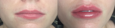 Juvederm before and after photo