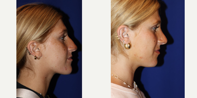 Rhinoplasty before and after photo