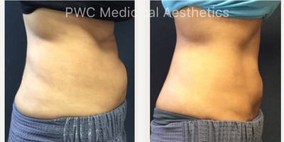 SculpSure before and after photo