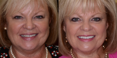 Smile Makeover before and after photo