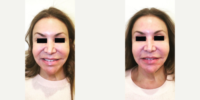 Dermal Fillers before and after photo