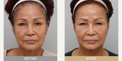 Facelift before and after photo