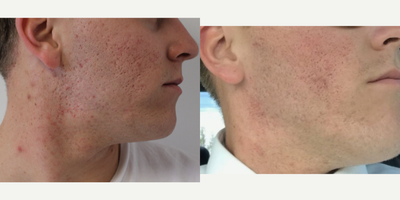 Fractora RF before and after photo