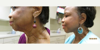 Neck Lift before and after photo