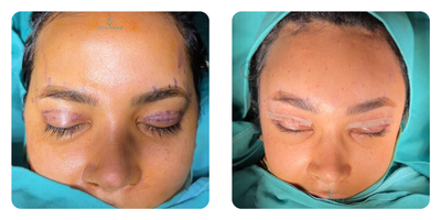 Eyelid Surgery before and after photo