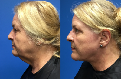 Facelift before and after photo