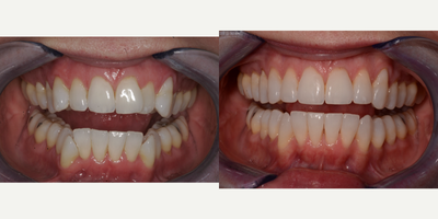 Invisalign before and after photo
