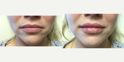 Lip Fillers before and after photo