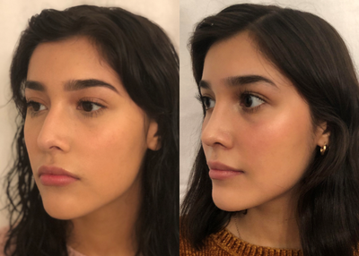Rhinoplasty before and after photo