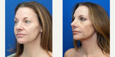 Rhinoplasty before and after photo