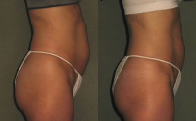 Skin Rejuvenation before and after photo