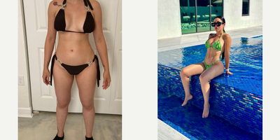 Breast Augmentation before and after photo