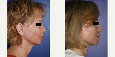 Cheek Augmentation before and after photo