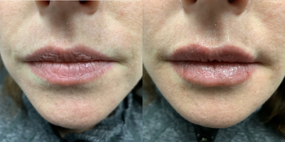 Dermal Fillers before and after photo