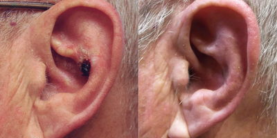 Ear Surgery before and after photo