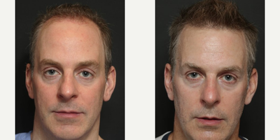 Hair Transplant before and after photo