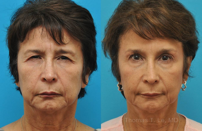 Brow Lift before and after photo