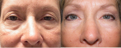 Brow Lift before and after photo