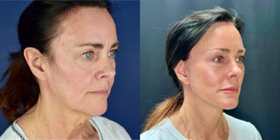 Neck Lift before and after photo