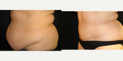 Tummy Tuck before and after photo