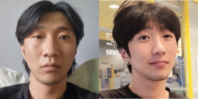 Alarplasty before and after photo