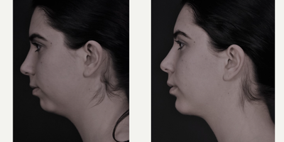 Chin Implant before and after photo
