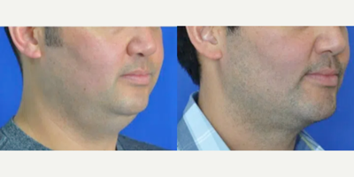 Chin Implant before and after photo