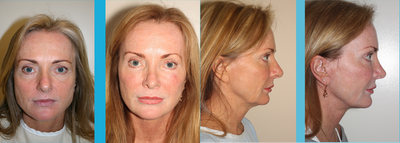 Eyelid Surgery before and after photo