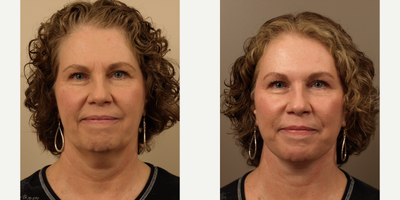 Facelift before and after photo