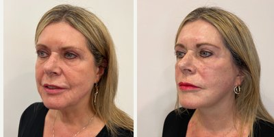 SMAS Facelift before and after photo
