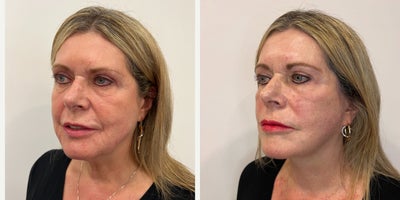 SMAS Facelift before and after photo