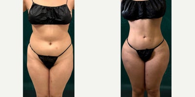 Liposuction before and after photo